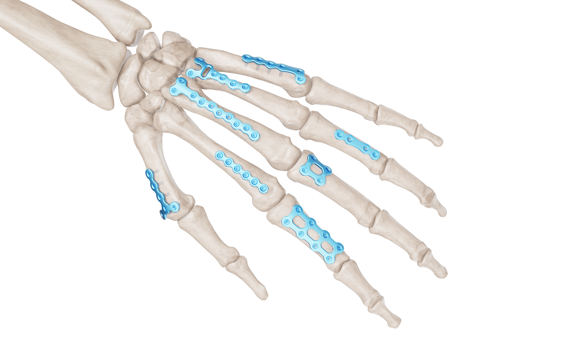 1.5 mm Mini Plaklar