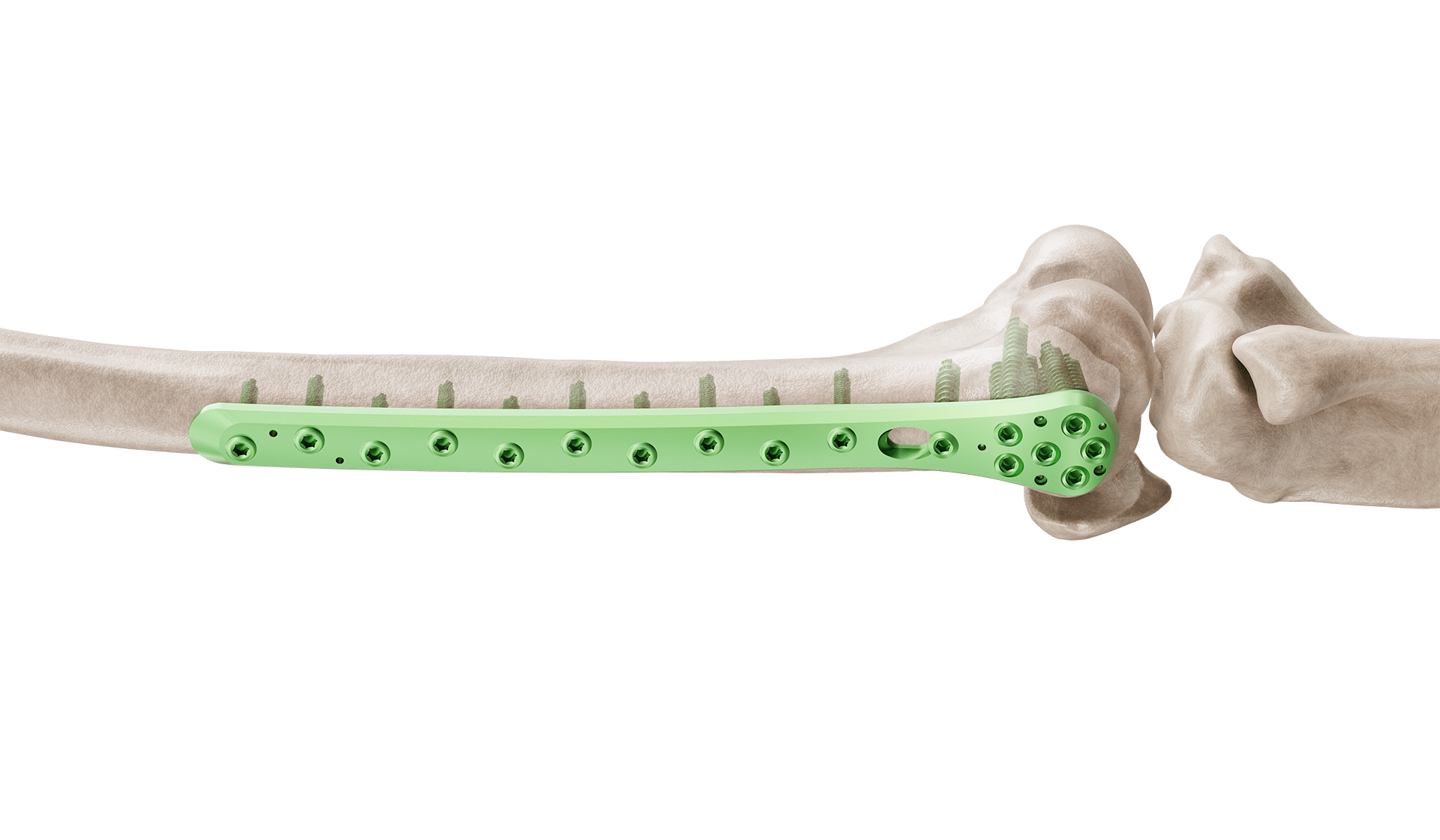 Distal Fibula Lateral Malleolar Anatomik Plak