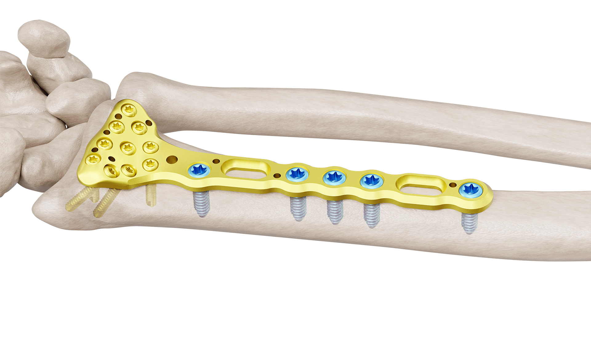 Distal Radyus Volar Anatomik Standart Plak