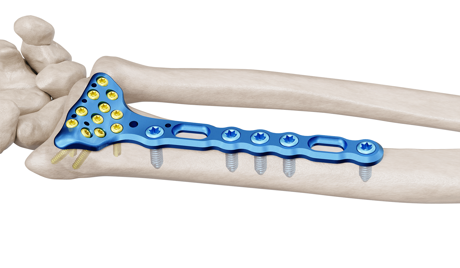 Distal Radyus Volar Anatomik Geniş Plak