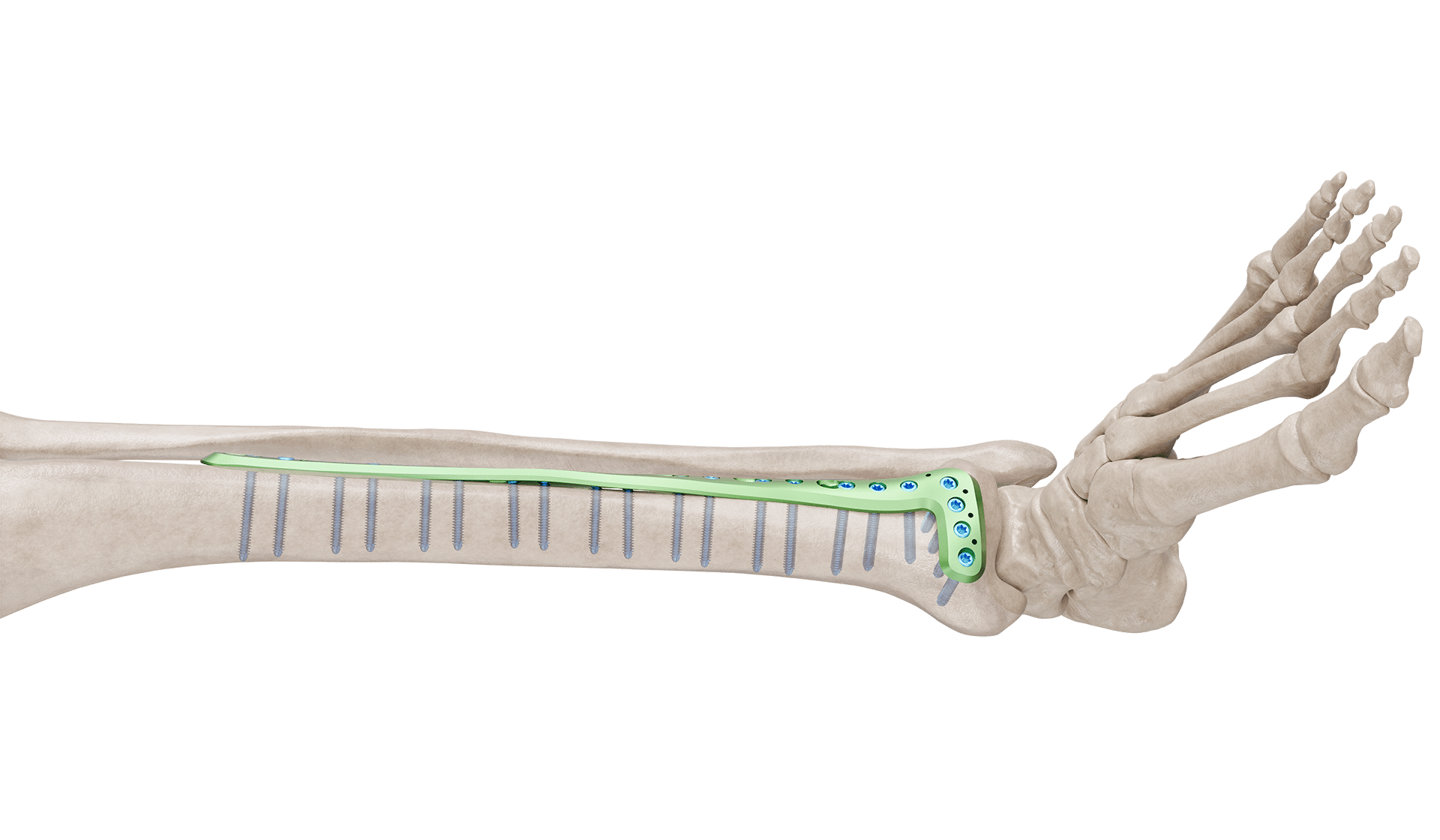 Distal Tibia Anterolateral Anatomik Plak