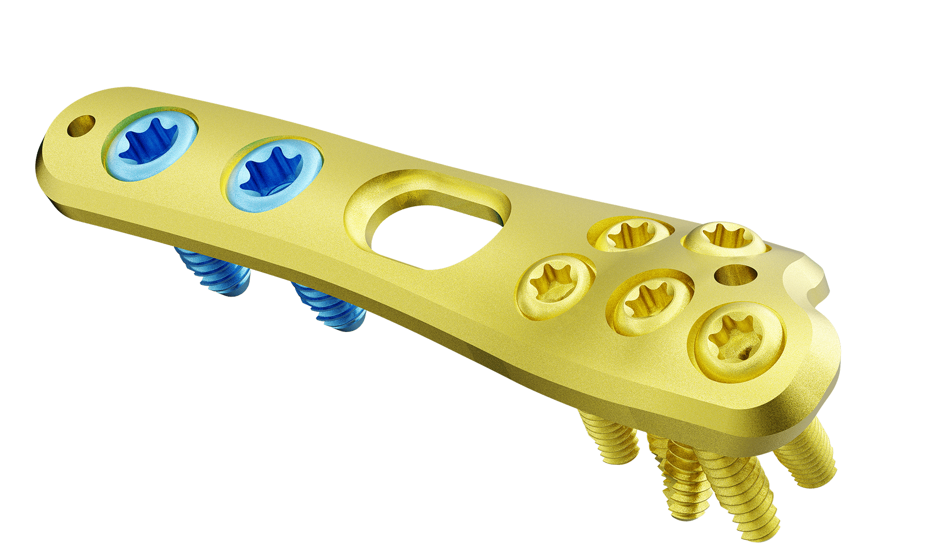Distal Ulna Anatomik Plak