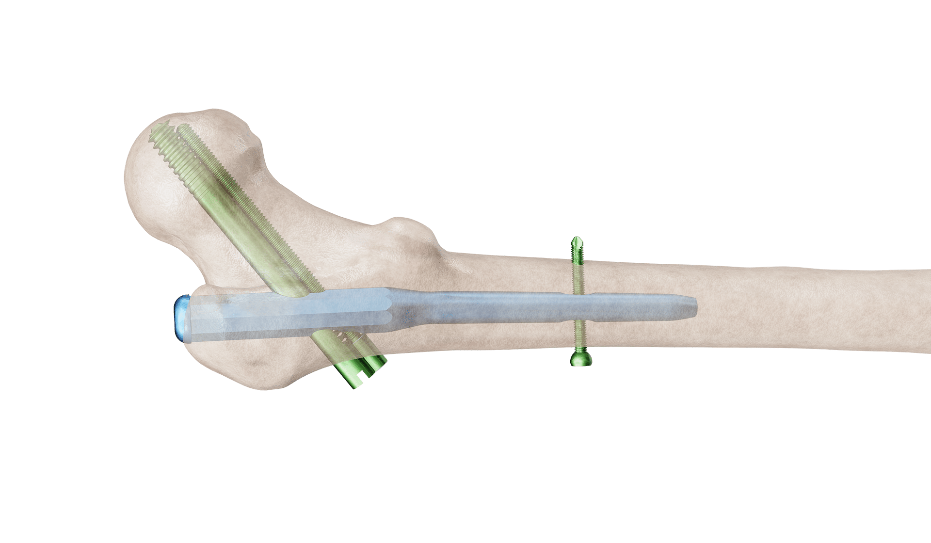 Proximal Femur Çivi (PFÇ) Plak