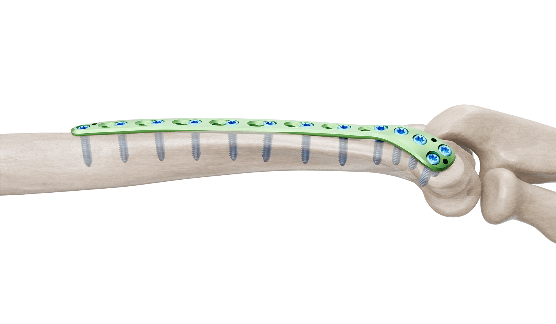 Distal Humerus Posterolateral Plak