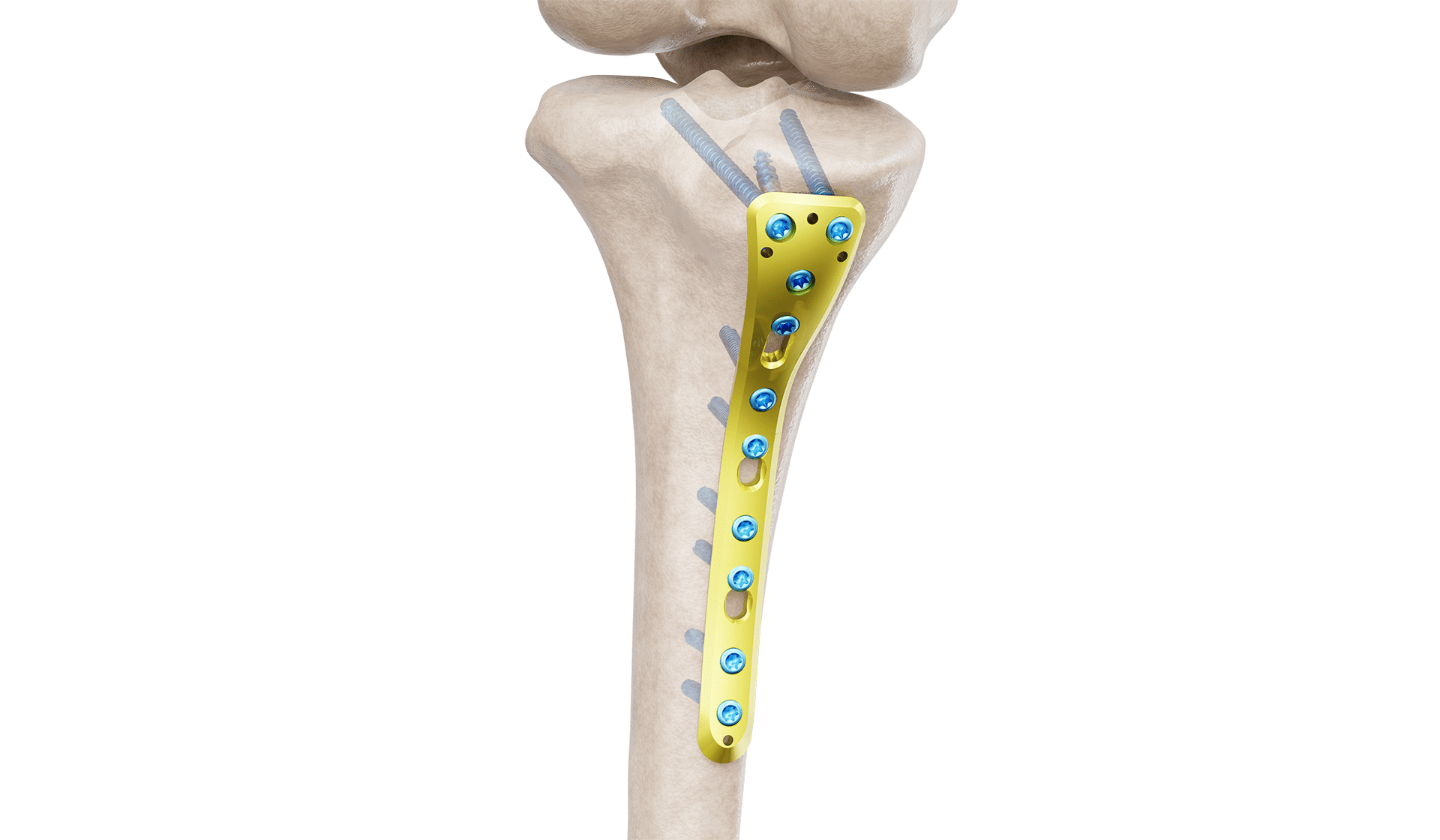 Proksimal Tibia Posteromedyal Plak