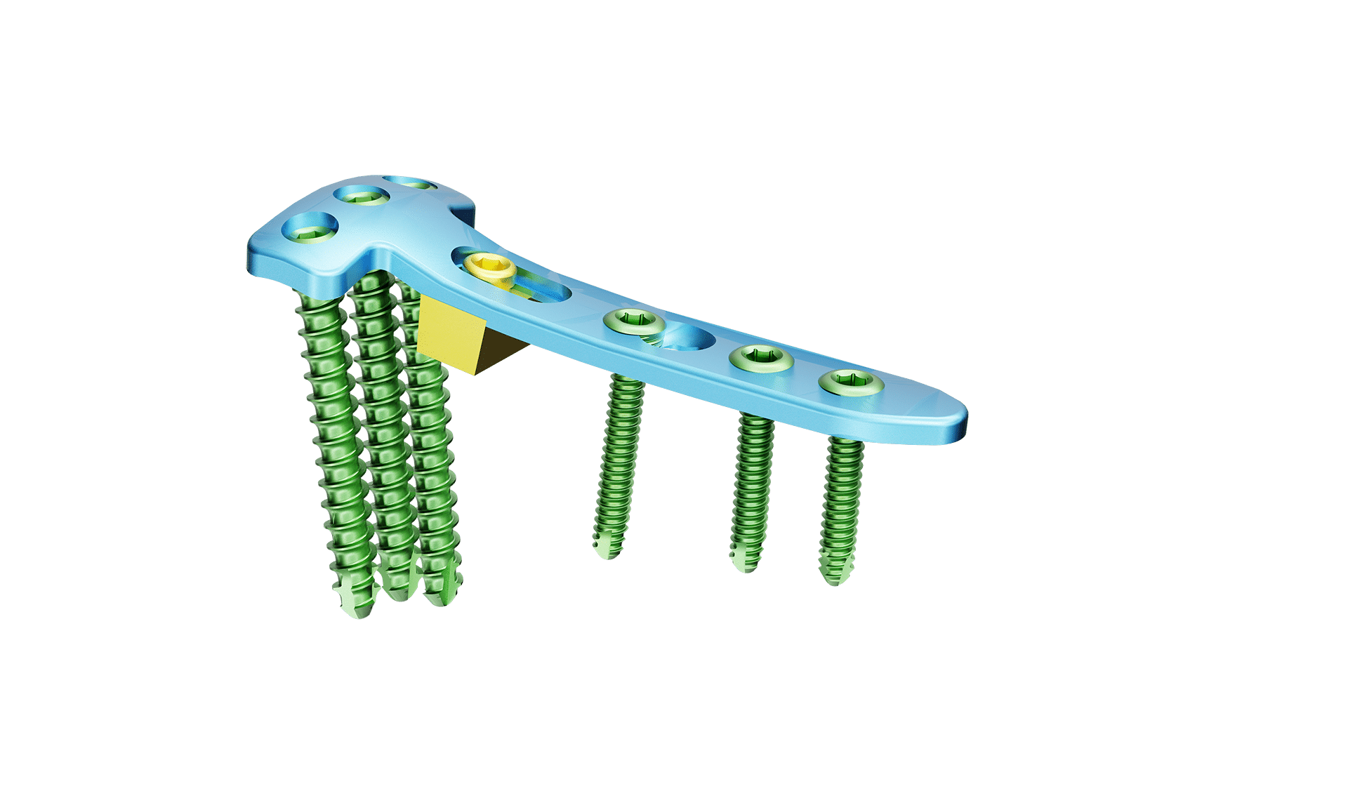 Proksimal Tibia Yüksek Osteotomi Plak