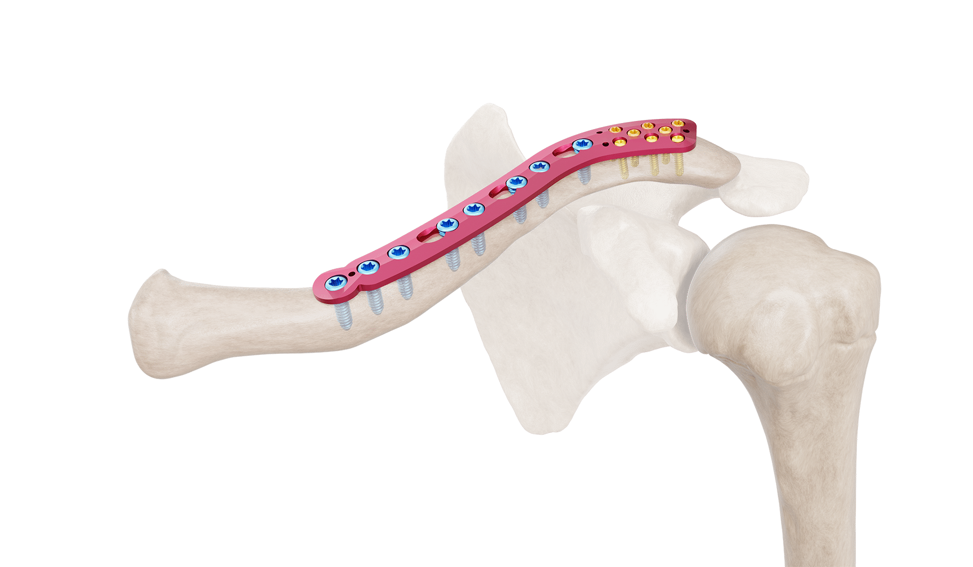 Superior Distal Clavicle Anatomic Plate