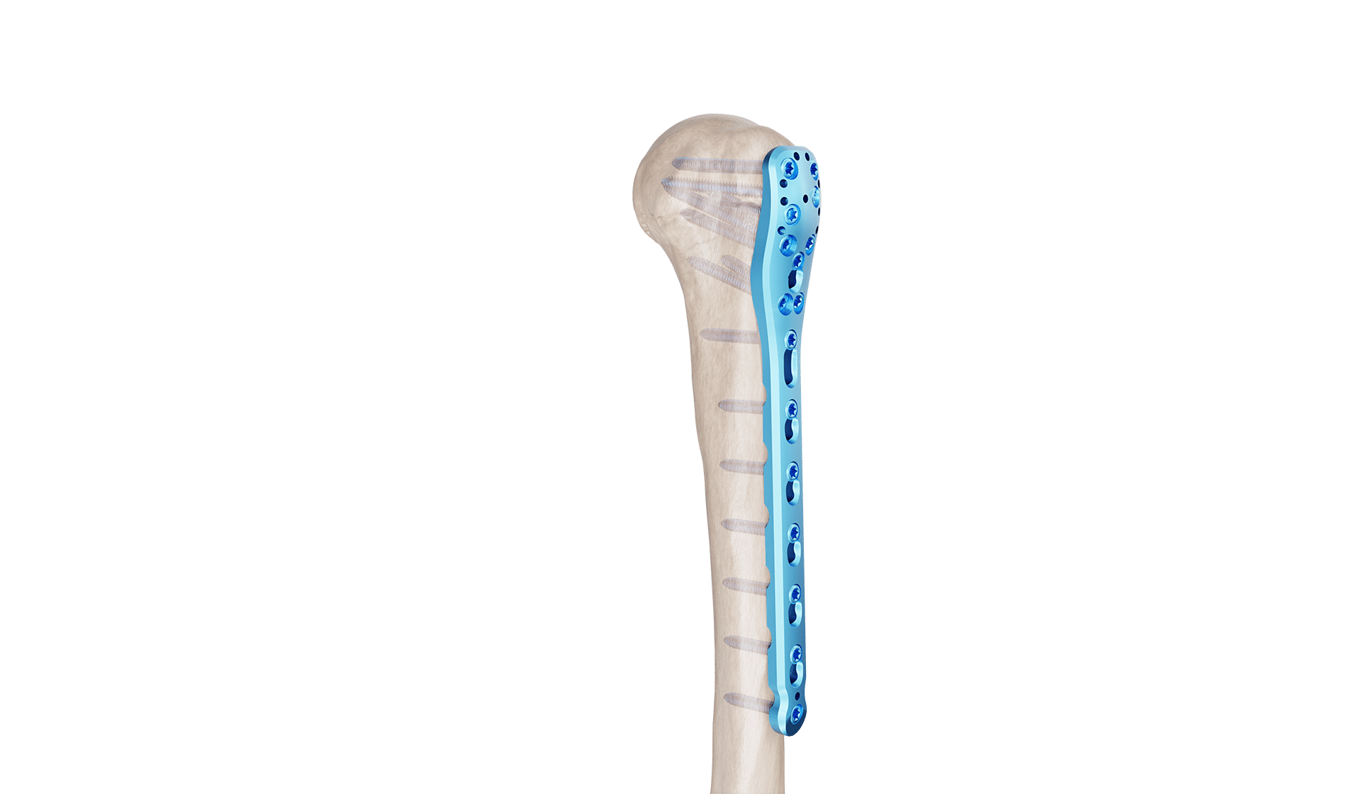 Proksimal Humerus Plak
