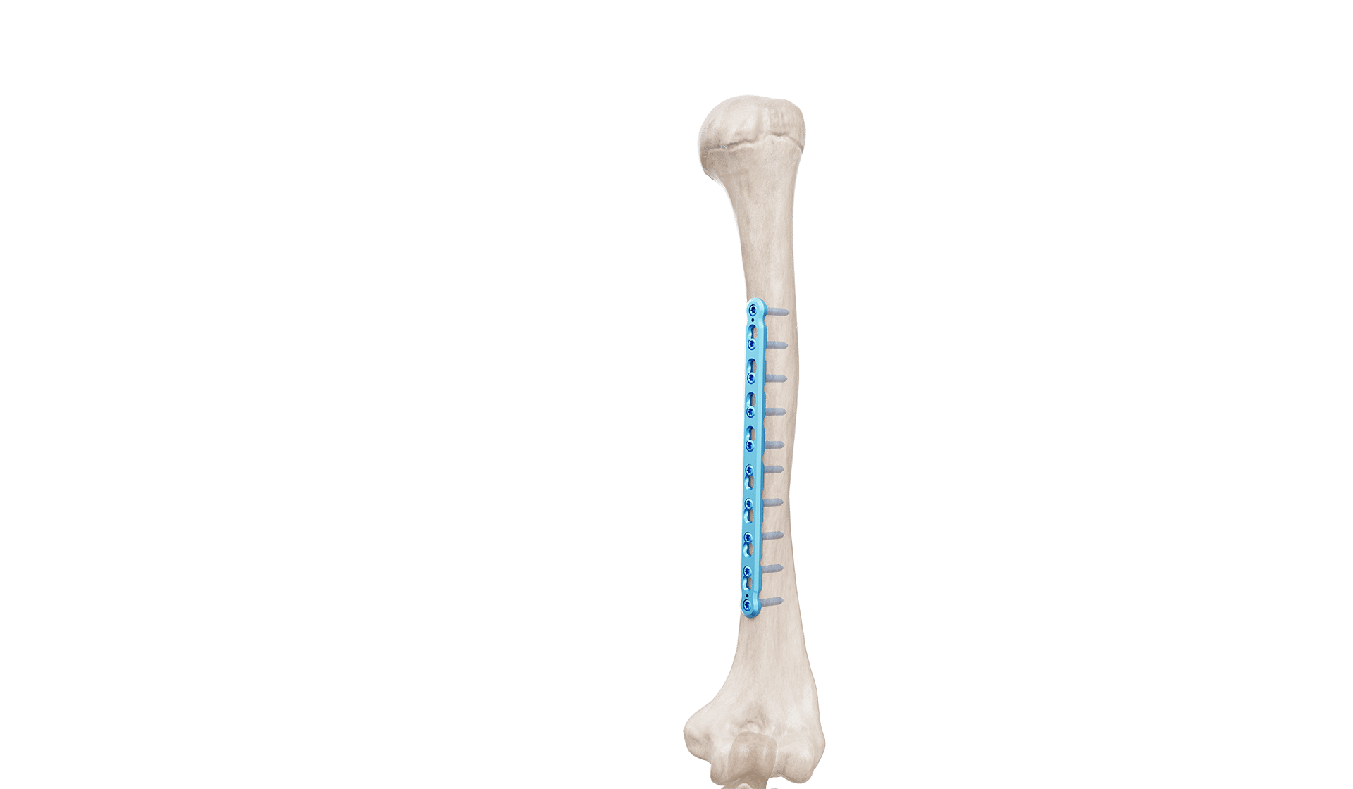3.5 mm Humerus Düz Plak