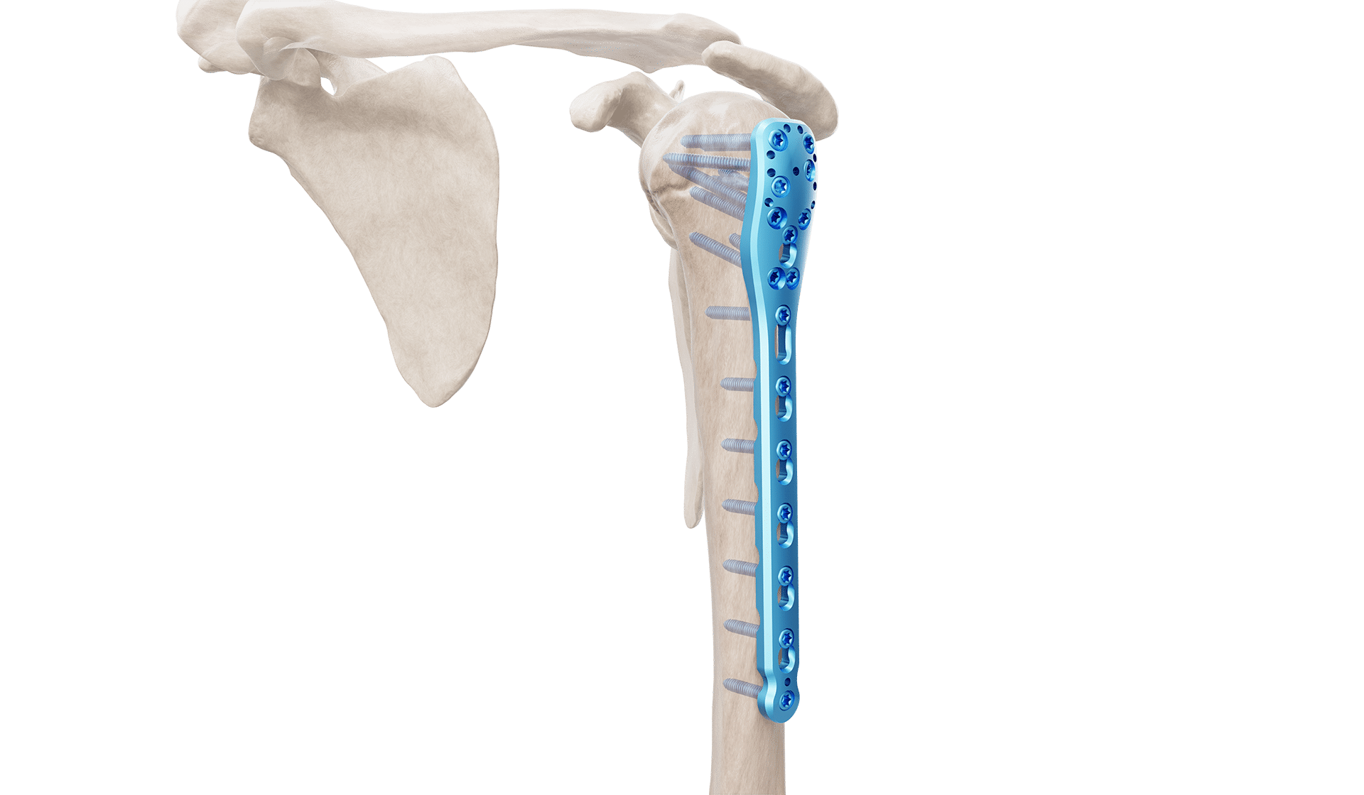 Proksimal Humerus Plak