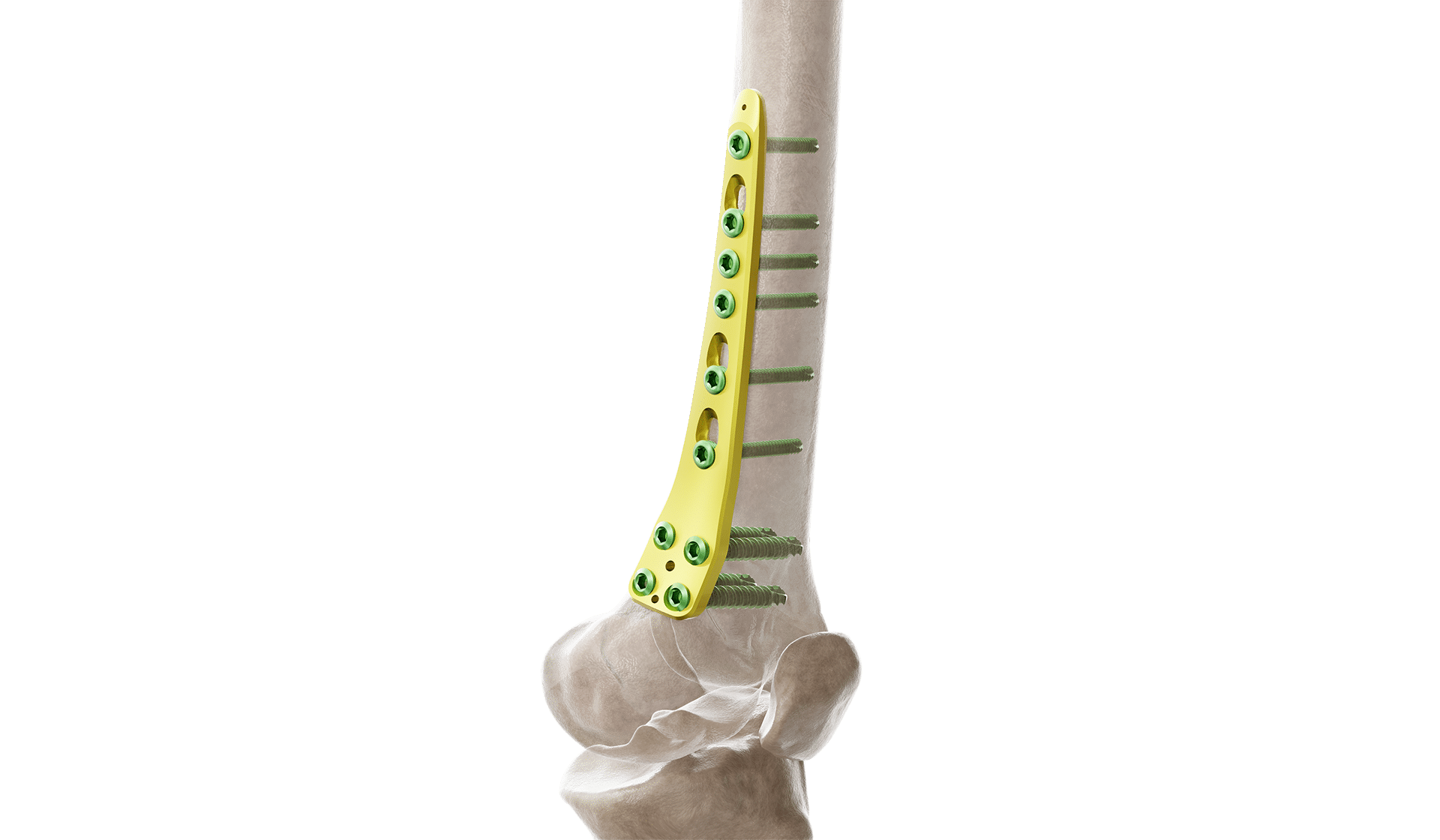 Distal Femur Medyal Anatomik Plak