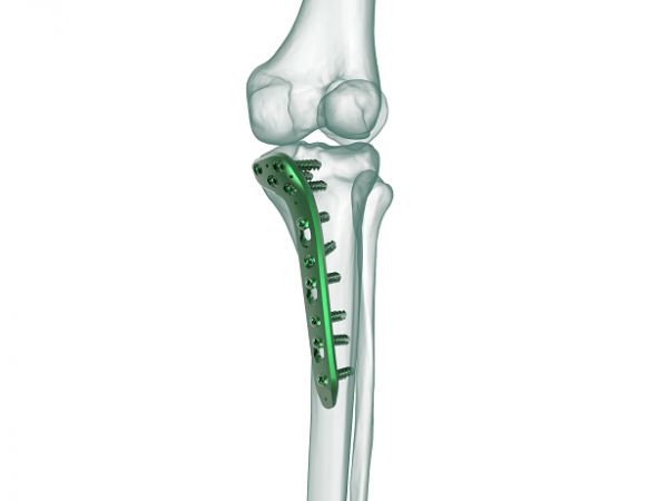 Medial Proximal Tibial Plate