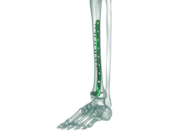 TRUE LOCK Distal Tibia Anterolateral Anatomic Plate TRUEMED Medikal