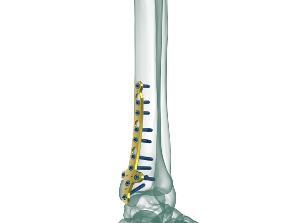 Distal Medial Tibia Locking Plate, Size: 4.5mm /3.5mm