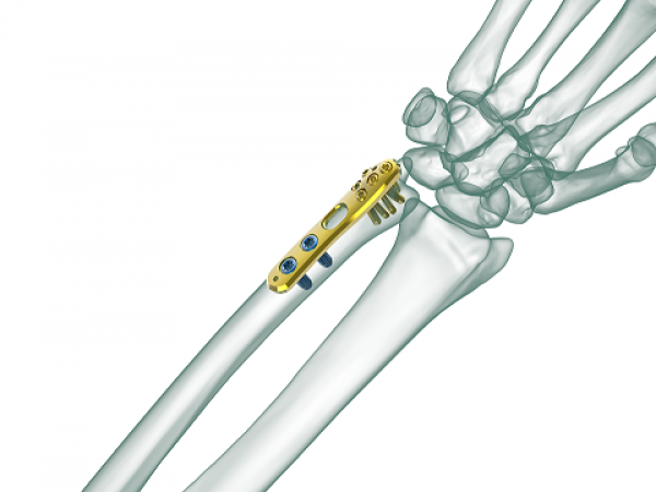 Distal Ulna Anatomic Locking Plate TRUEMED Medikal