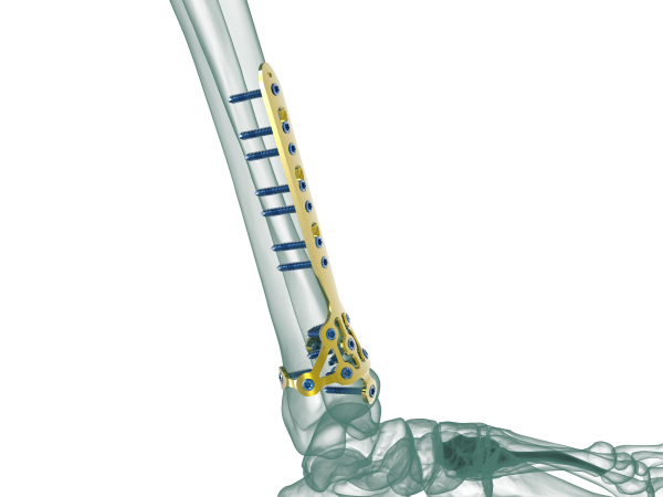 pilon fracture recovery blog