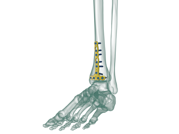 True Distal Tibia Anterior Anatomic Locking Plate Truemed Medikal