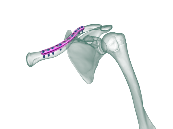 Clavicle Kilitli Plak