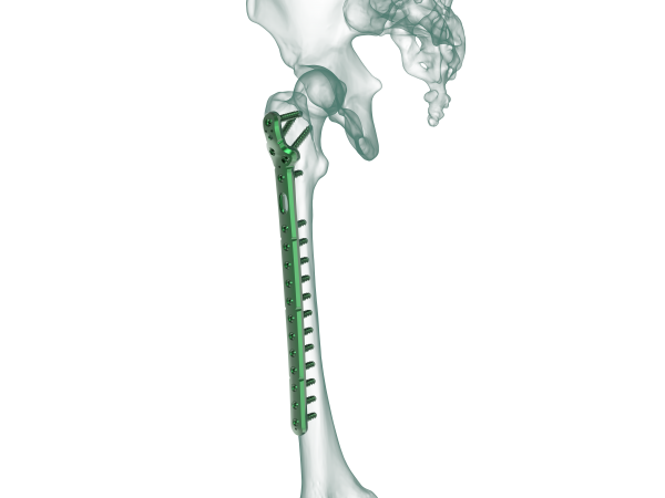 Proximal Femur Lateral Locking Plate Truemed Medikal