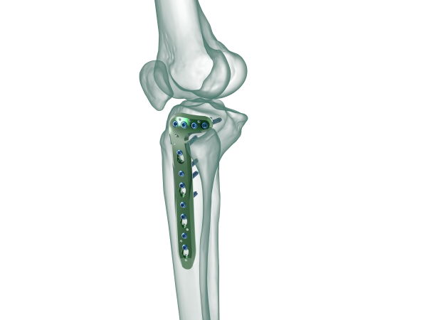 TRUE LOCK Proximal Tibia Lateral Anatomic Plate TRUEMED Medikal