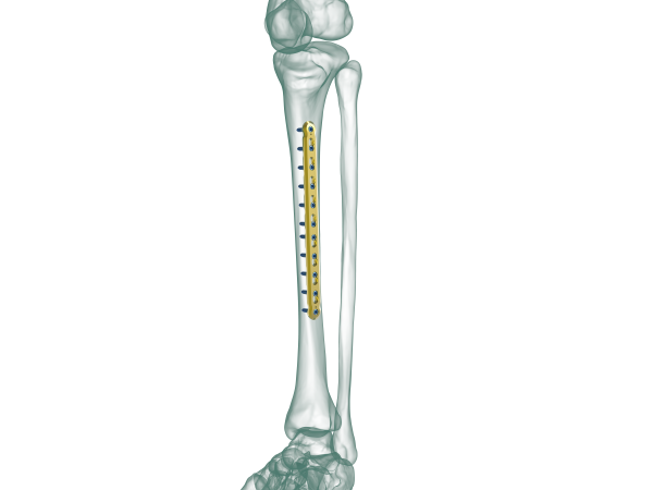 TRUE LOCK Tibia Straight Plate TRUEMED Medikal